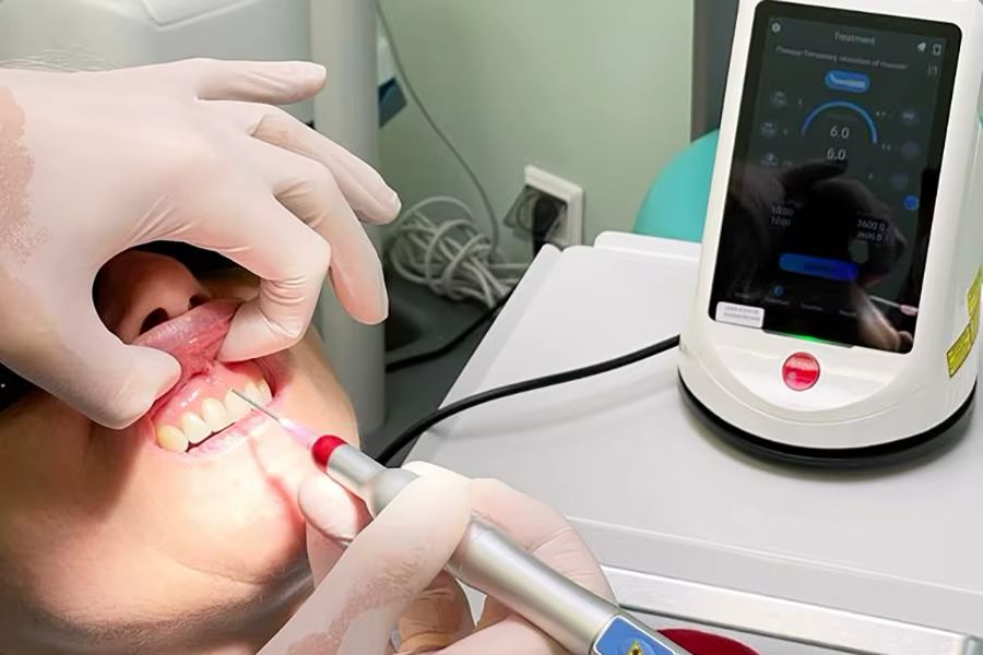 Laser dentar Berylas